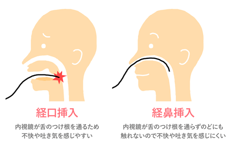 鼻から挿入する細経の経鼻内視鏡を選択することもできます。